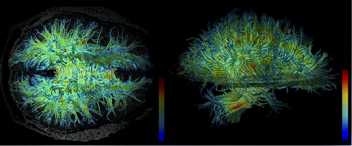 Diffuse tensor image of High resolution data acquired on 3 Tesla magnet in schizophrenia