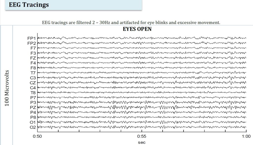 EEG tracings for one minute