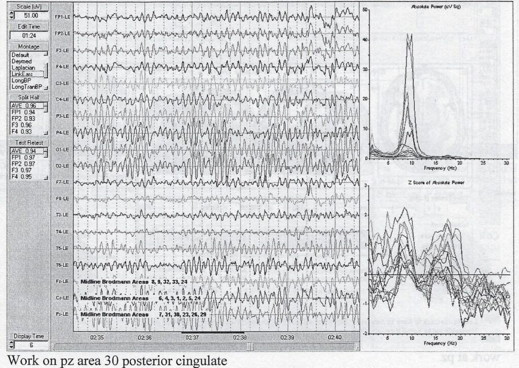 scan of grey scale prinout showing EEG readings with absolute power peak