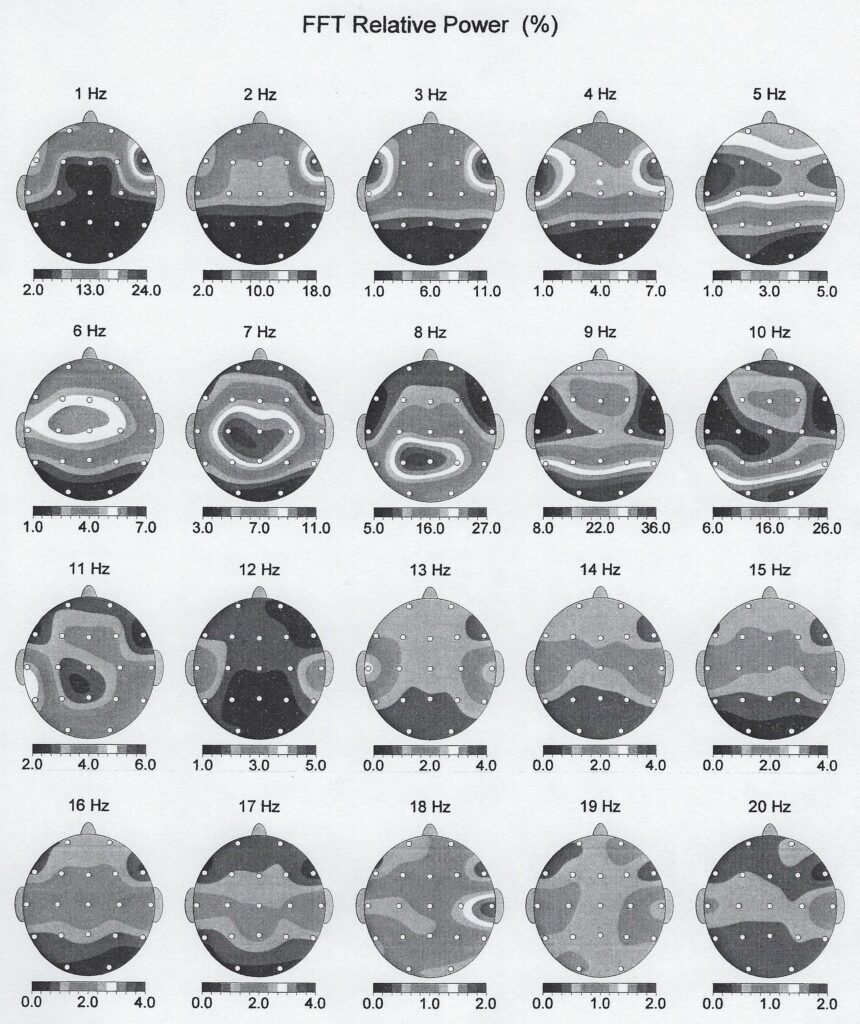 scan of grey scale printout of brain maps